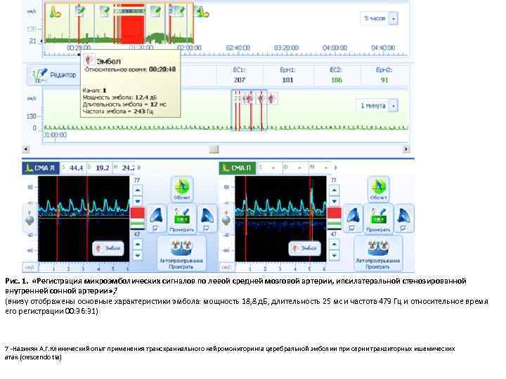 Рис. 1. «Регистрация микроэмболических сигналов по левой средней мозговой артерии, ипсилатеральной стенозированной внутренней сонной