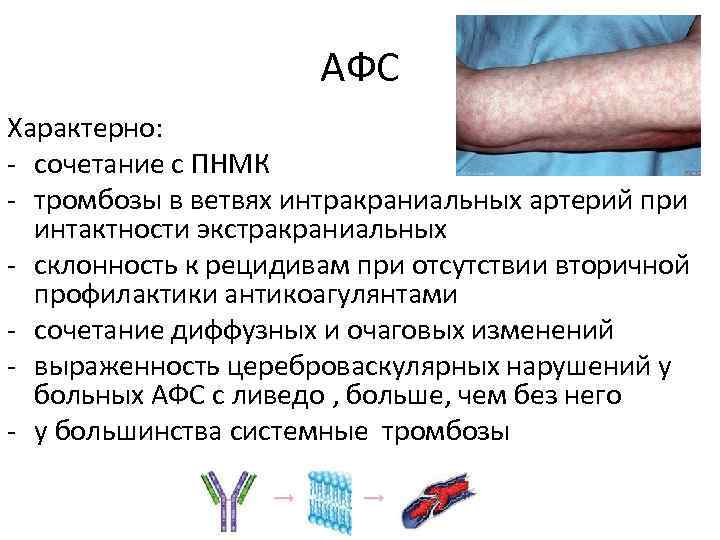АФС Характерно: - сочетание с ПНМК - тромбозы в ветвях интракраниальных артерий при интактности