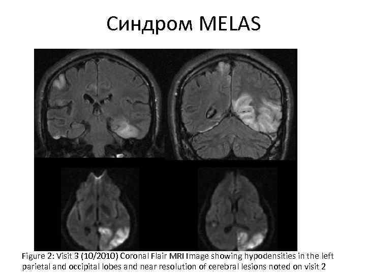 Синдром MELAS Figure 2: Visit 3 (10/2010) Coronal Flair MRI Image showing hypodensities in