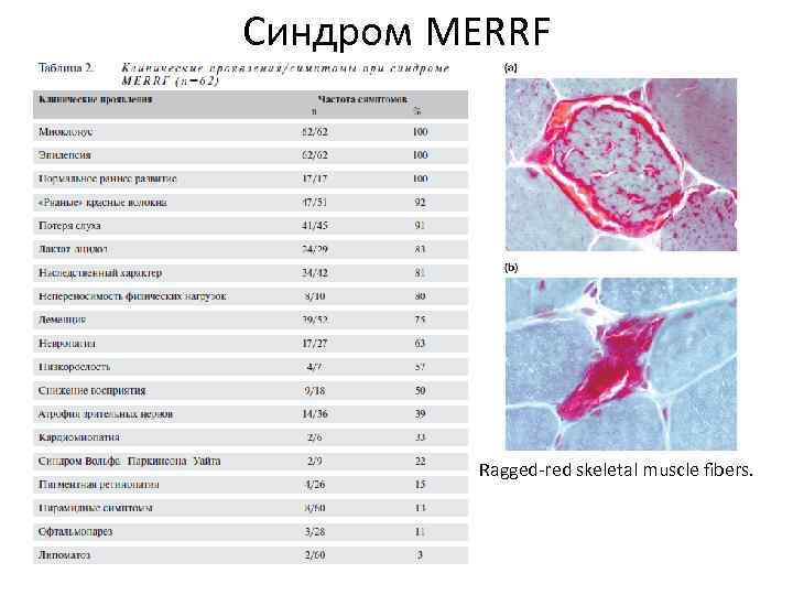 Синдром MERRF Ragged-red skeletal muscle fibers. 