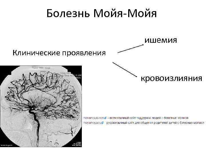 Болезнь Мойя-Мойя ишемия Клинические проявления кровоизлияния 