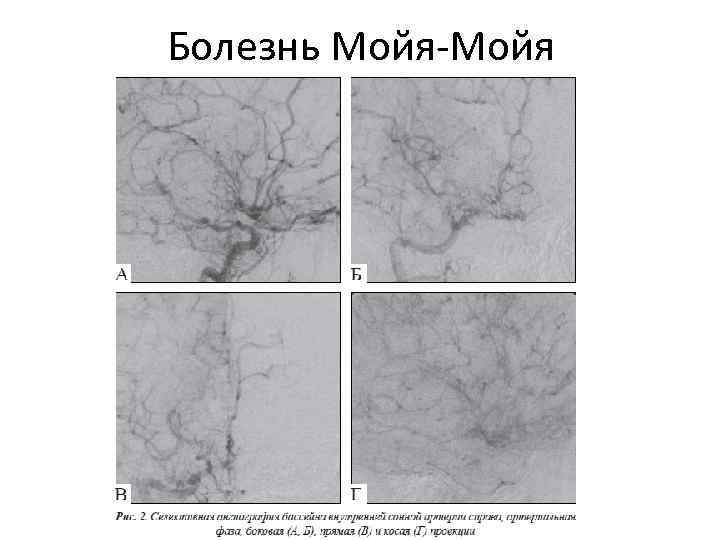 Болезнь Мойя-Мойя 