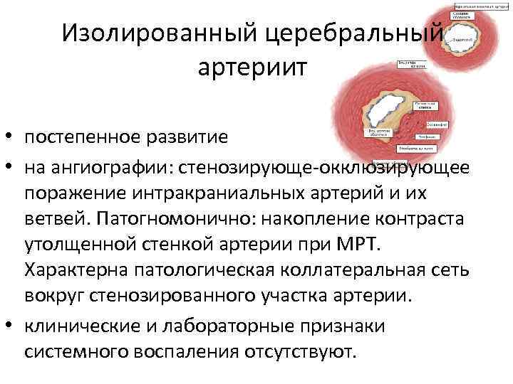 Изолированный церебральный артериит • постепенное развитие • на ангиографии: стенозирующе-окклюзирующее поражение интракраниальных артерий и