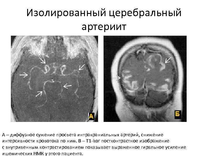 Изолированный церебральный артериит А – диффузное сужение просвета интракраниальных артерий, снижение интерсивности кровотока по