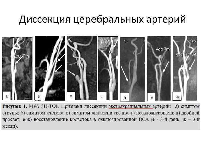 Диссекция церебральных артерий 
