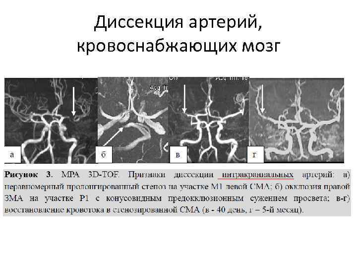 Диссекция артерий, кровоснабжающих мозг 