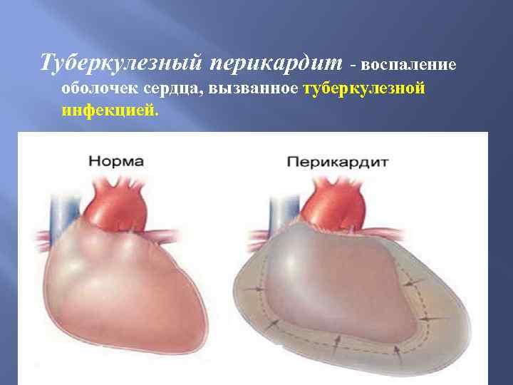 Туберкулезный перикардит - воспаление оболочек сердца, вызванное туберкулезной инфекцией. 