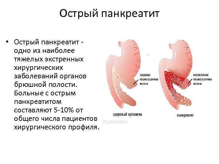 Острый панкреатит • Острый панкреатит - одно из наиболее тяжелых экстренных хирургических заболеваний органов