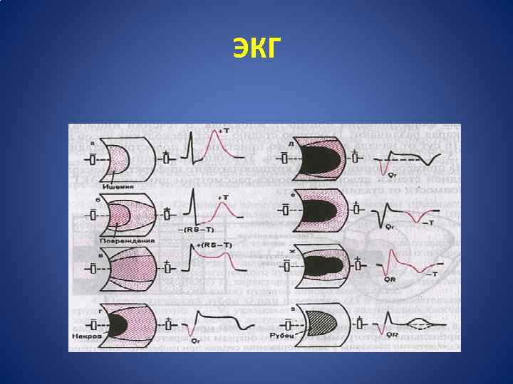ЭКГ 