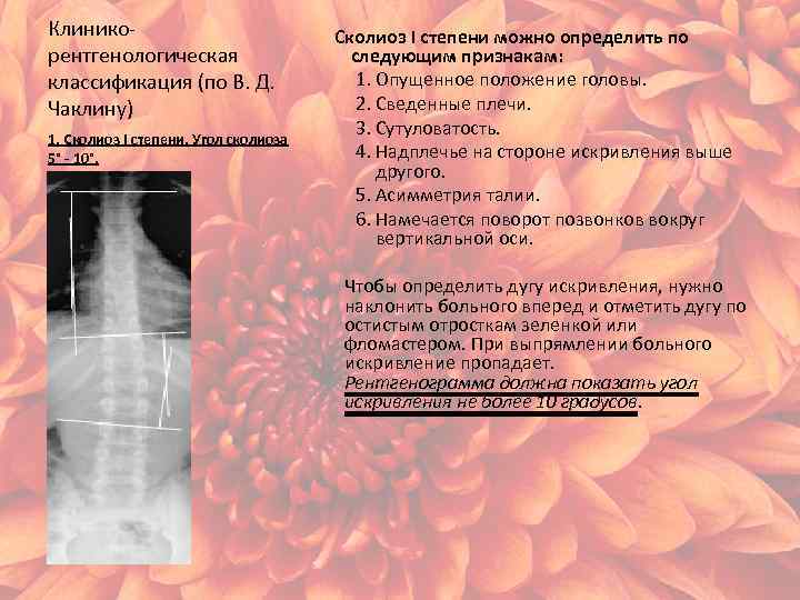 Сколиоз 1 степени группа здоровья