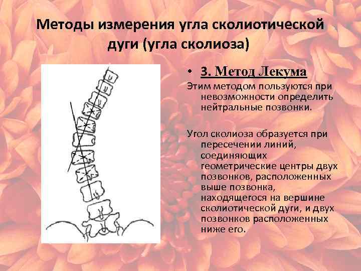 Угол кобба. Метод Фергюсона сколиоз. Метод Кобба сколиоз. Угол сколиоза метод Фергюсона. Сколиотическая дуга метод Кобба степени.