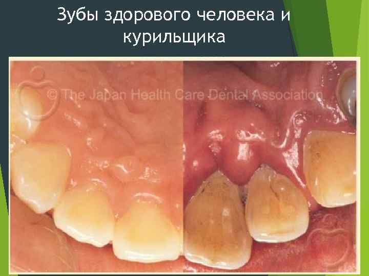 Зубы здорового человека и курильщика 