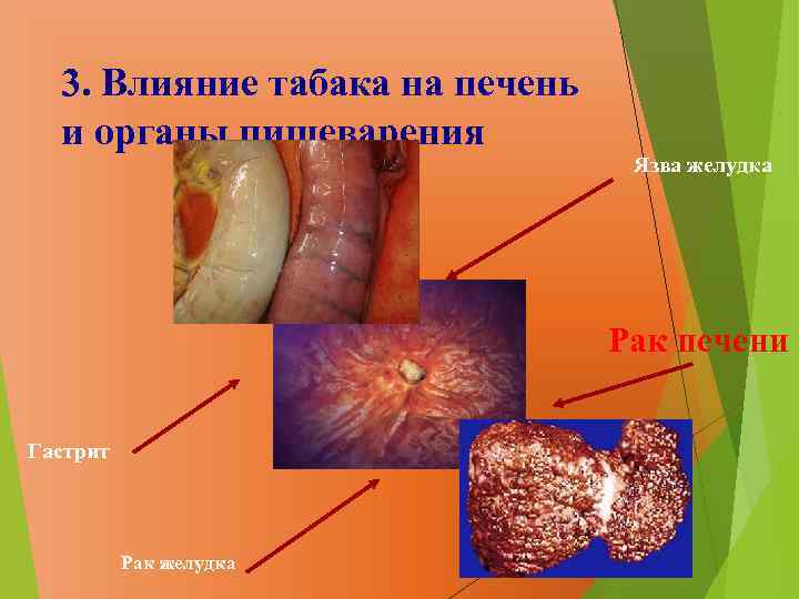 3. Влияние табака на печень и органы пищеварения Язва желудка Рак печени Гастрит Рак