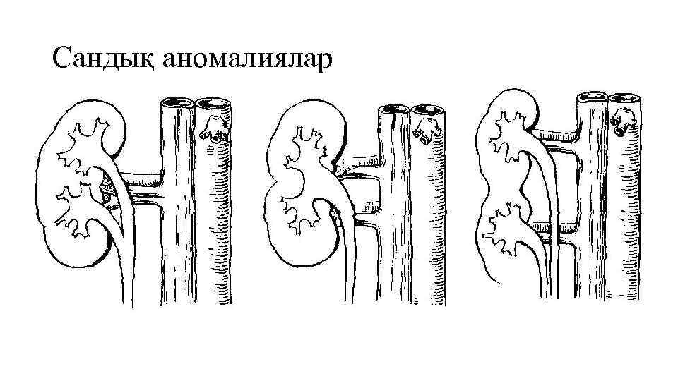 Сандық аномалиялар • Аплазия- 