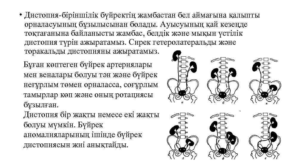  • Дистопия-біріншілік бүйректің жамбастан бел аймағына қалыпты орналасуының бұзылысынан болады. Ауысуының қай кезеңде