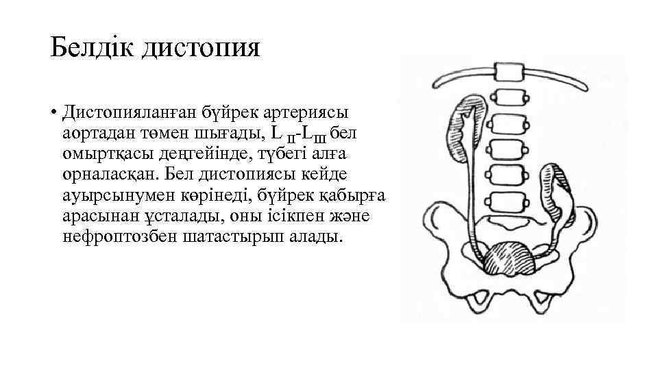 Белдік дистопия • Дистопияланған бүйрек артерияcы аортадан төмен шығады, L ІІ-LІІІ бел омыртқасы деңгейінде,
