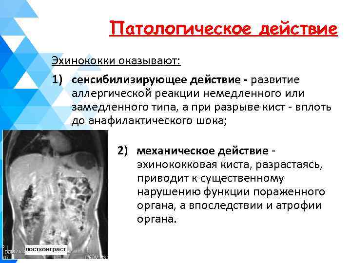 Патологическое действие Эхинококки оказывают: 1) сенсибилизирующее действие - развитие аллергической реакции немедленного или замедленного