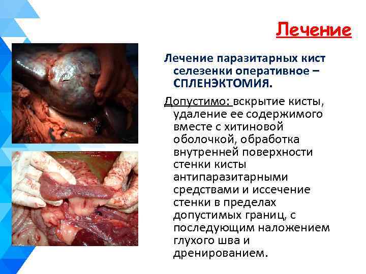 Лечение паразитарных кист селезенки оперативное – СПЛЕНЭКТОМИЯ. Допустимо: вскрытие кисты, удаление ее содержимого вместе