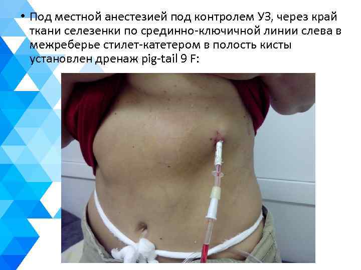  • Под местной анестезией под контролем УЗ, через край ткани селезенки по срединно-ключичной