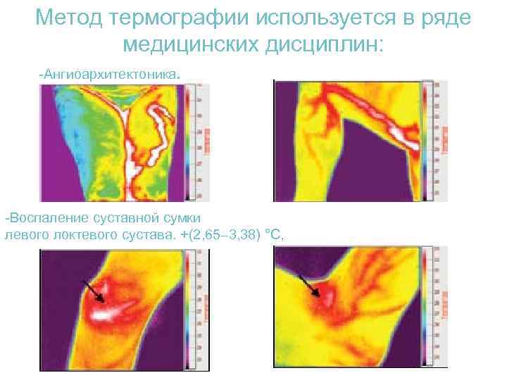 Метод термографии используется в ряде медицинских дисциплин: -Ангиоархитектоника. -Воспаление суставной сумки левого локтевого сустава.