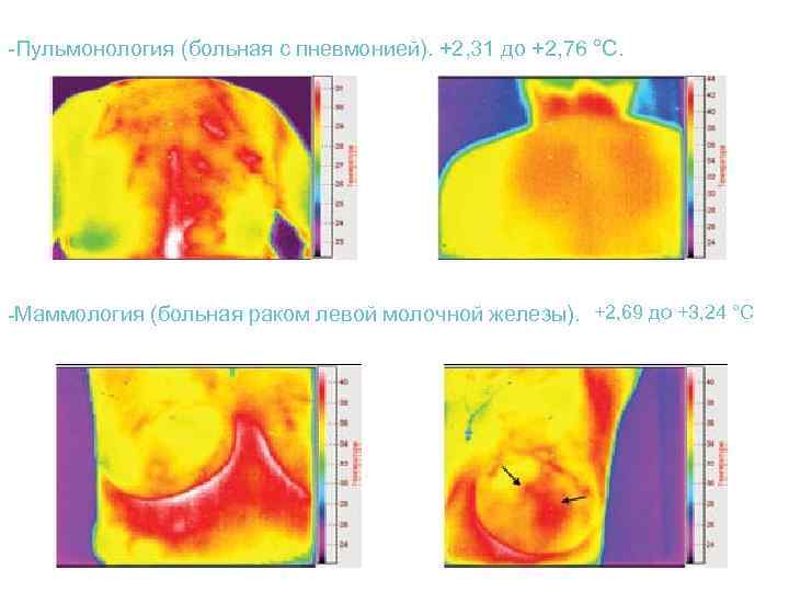 -Пульмонология (больная с пневмонией). +2, 31 до +2, 76 °С. -Маммология (больная раком левой