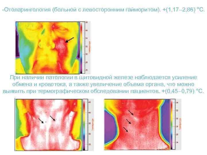 -Отоларингология (больной с левосторонним гайморитом). +(1, 17– 2, 86) °С. При наличии патологии в