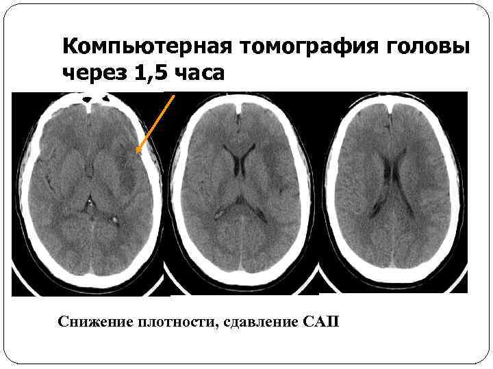 Компьютерная томография головы через 1, 5 часа Снижение плотности, сдавление САП 