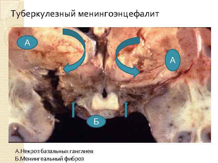 Заболевания нервной системы картинки