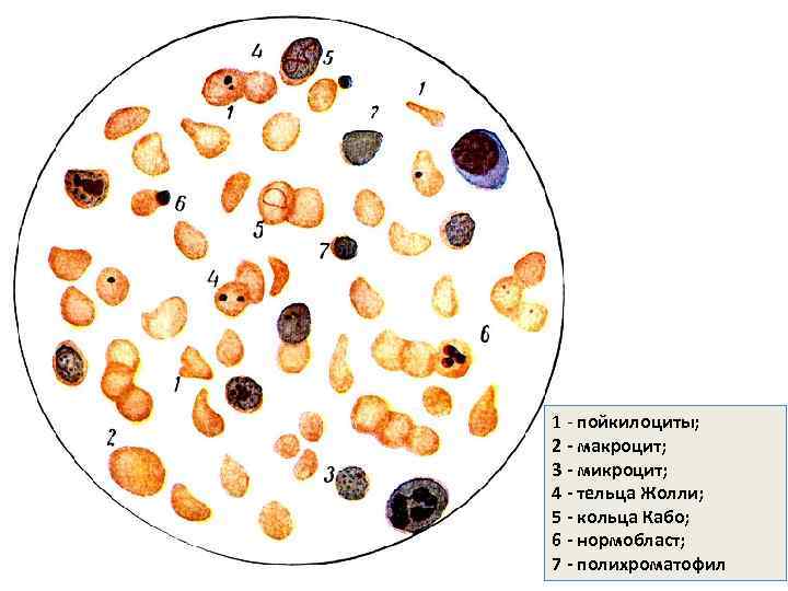 1 - пойкилоциты; 2 - макроцит; 3 - микроцит; 4 - тельца Жолли; 5