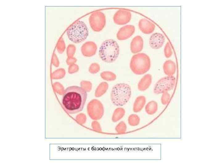 Эритроциты с базофильной пунктацией. 