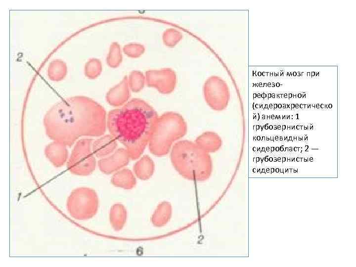 Костный мозг при железорефрактерной (сидероахрестическо й) анемии: 1 грубозернистый кольцевидный сидеробласт; 2 — грубозернистые