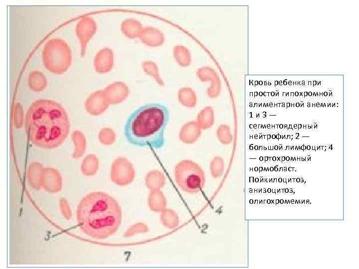 Кровь ребенка при простой гипохромной алиментарной анемии: 1 и 3 — сегментоядерный нейтрофил; 2