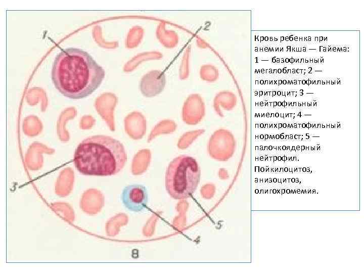 Кровь ребенка при анемии Якша — Гайема: 1 — базофильный мегалобласт; 2 — полихроматофильный