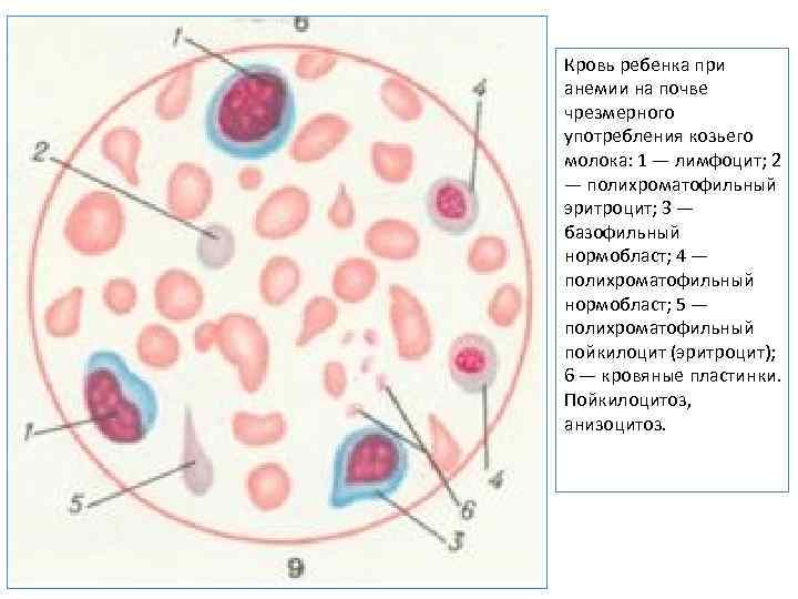 Кровь ребенка при анемии на почве чрезмерного употребления козьего молока: 1 — лимфоцит; 2