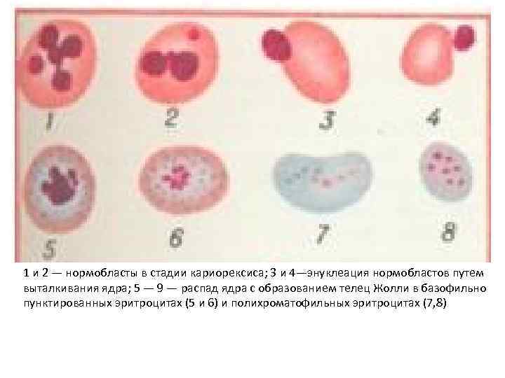 1 и 2 — нормобласты в стадии кариорексиса; 3 и 4—энуклеация нормобластов путем выталкивания