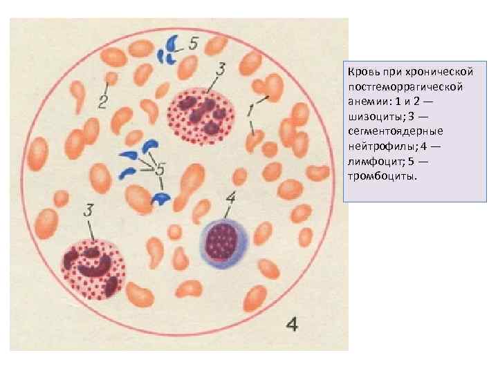 Кровь при хронической постгеморрагической анемии: 1 и 2 — шизоциты; 3 — сегментоядерные нейтрофилы;