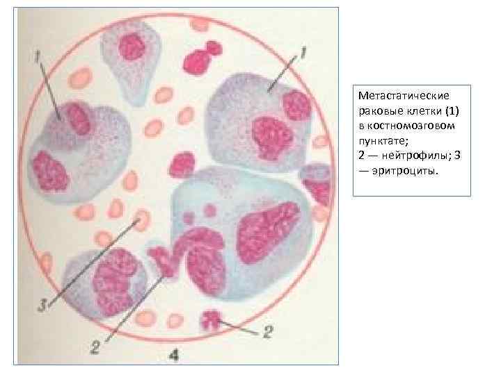 Метастатические раковые клетки (1) в костномозговом пунктате; 2 — нейтрофилы; 3 — эритроциты. 