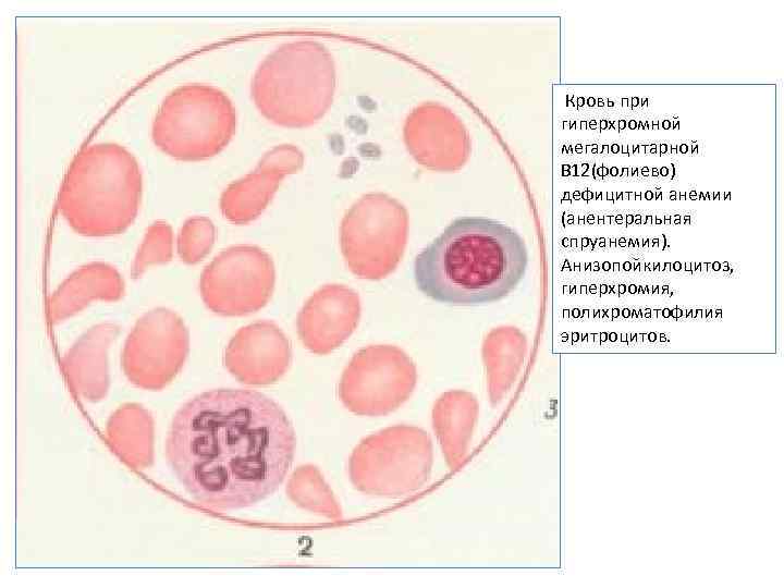  Кровь при гиперхромной мегалоцитарной В 12(фолиево) дефицитной анемии (анентеральная спруанемия). Анизопойкилоцитоз, гиперхромия, полихроматофилия