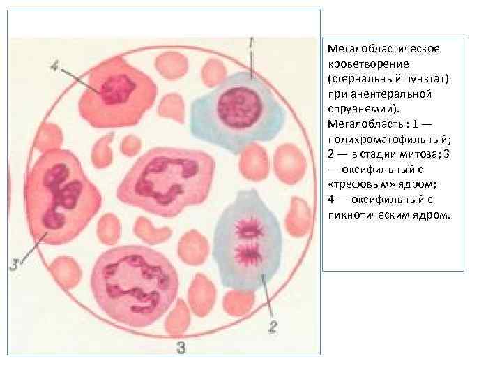 Мегалобластическое кроветворение (стернальный пунктат) при анентеральной спруанемии). Мегалобласты: 1 — полихроматофильный; 2 — в