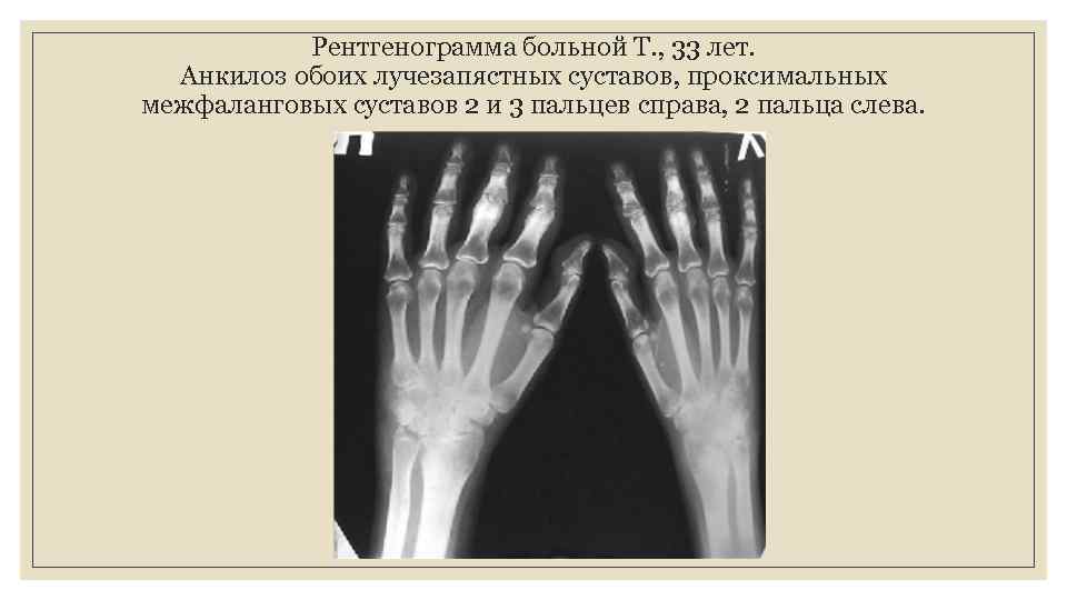 Рентгенограмма больной Т. , 33 лет. Анкилоз обоих лучезапястных суставов, проксимальных межфаланговых суставов 2