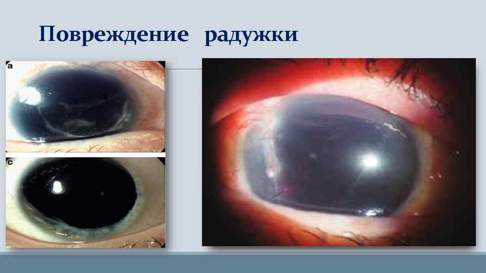 Повреждение радужки ØКольца Фоссиуса ØМиоз ØИридодиализ ØТравматическая аниридия 