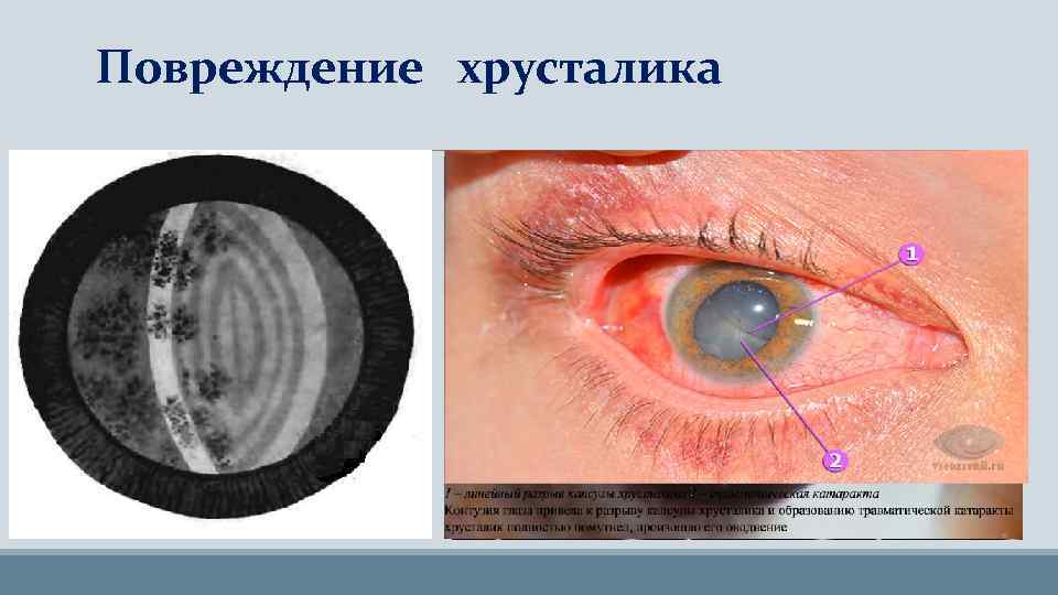 Повреждение хрусталика ØПодвывих (сублюксация) ØВывих (люксация) ØРазрыв капсулы хрусталика ØТравматическая катаракта ØСидероз 