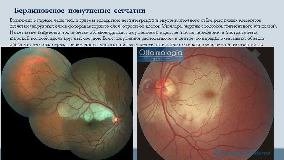 Берлиновское помутнение сетчатки Возникает в первые часы после травмы вследствие дезинтеграции и внутриклеточного отёка