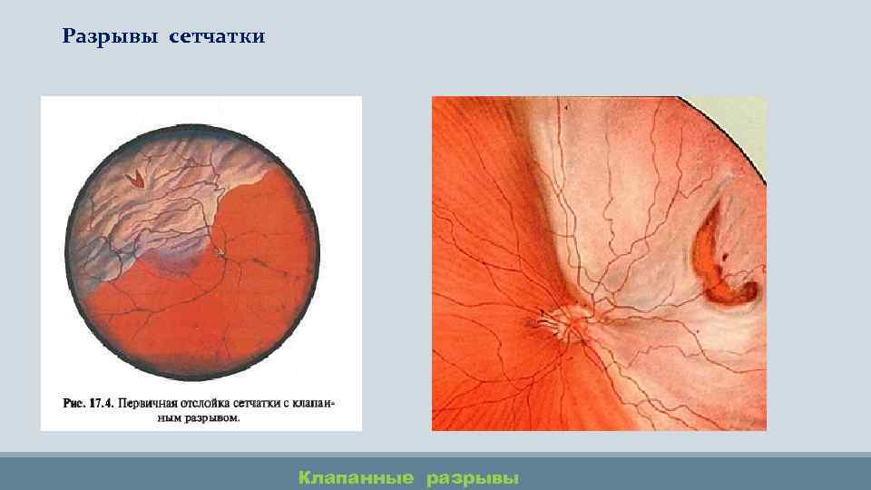 Разрывы сетчатки Клапанные разрывы 