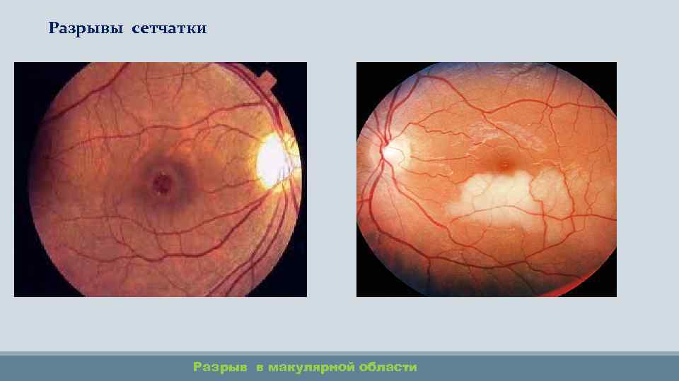 Разрывы сетчатки Разрыв в макулярной области 