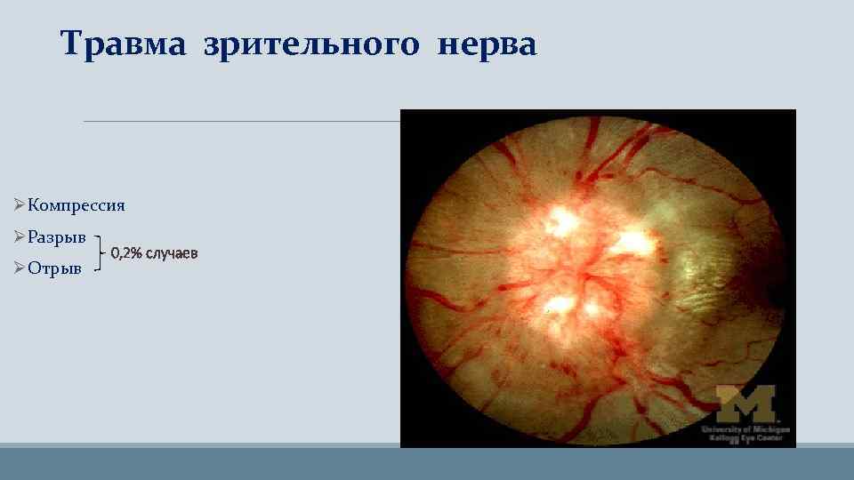 Травма зрительного нерва ØКомпрессия ØРазрыв ØОтрыв 0, 2% случаев 