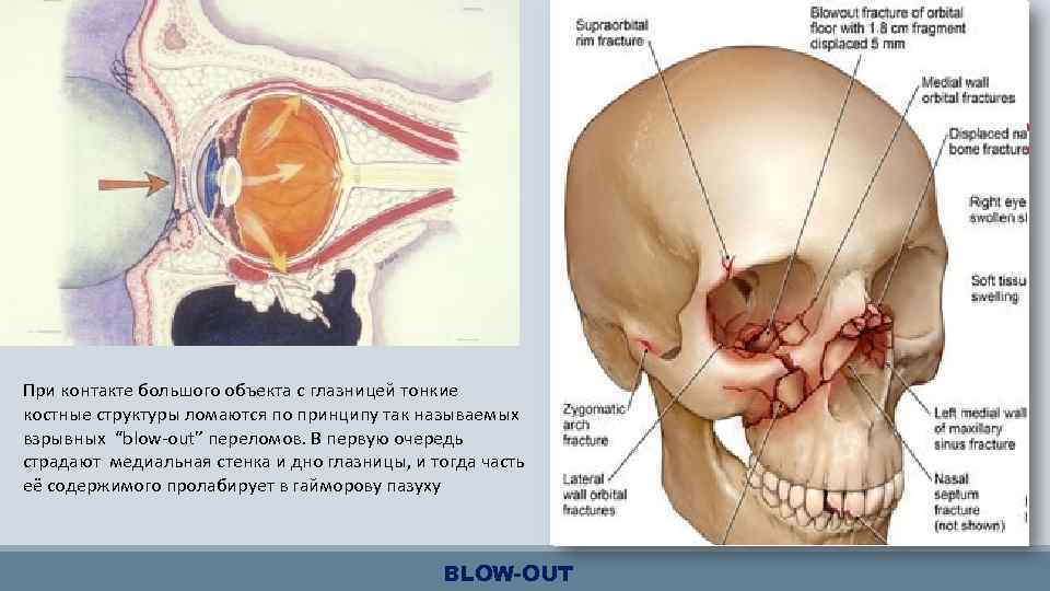 При контакте большого объекта с глазницей тонкие костные структуры ломаются по принципу так называемых