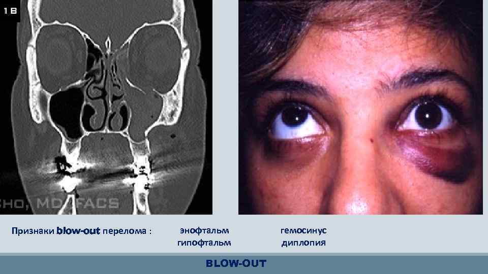 Признаки blow-out перелома : энофтальм гипофтальм BLOW-OUT гемосинус диплопия 
