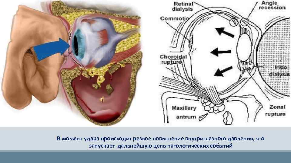 В момент удара происходит резкое повышение внутриглазного давления, что запускает дальнейшую цепь патологических событий