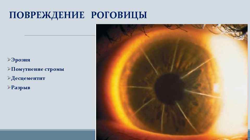 ПОВРЕЖДЕНИЕ РОГОВИЦЫ ØЭрозия ØПомутнение стромы ØДесцементит ØРазрыв 